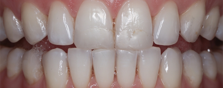 NuVeneers by Dr. Raanan Before & After Image