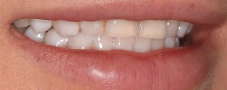 NuVeneers by Dr. Raanan Before & After Image