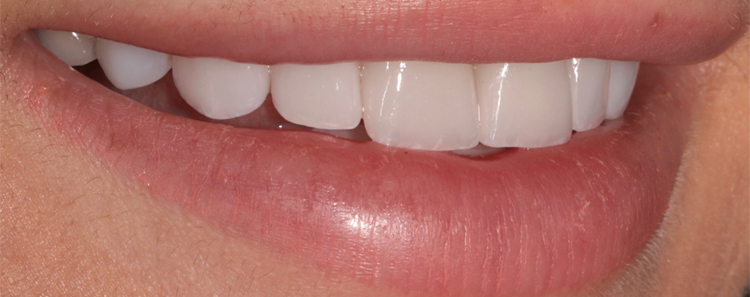 NuVeneers by Dr. Raanan Before & After Image