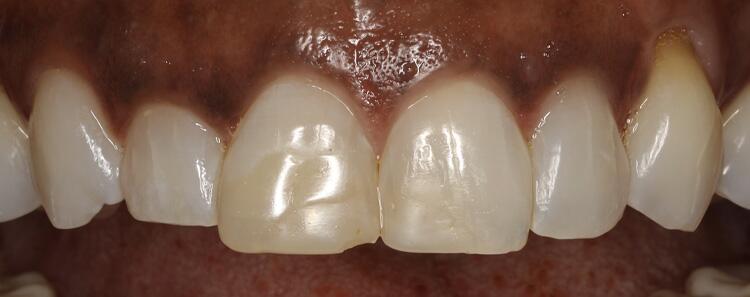 NuVeneers by Dr. Raanan Before & After Image