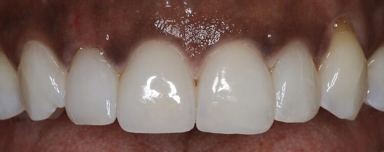 NuVeneers by Dr. Raanan Before & After Image