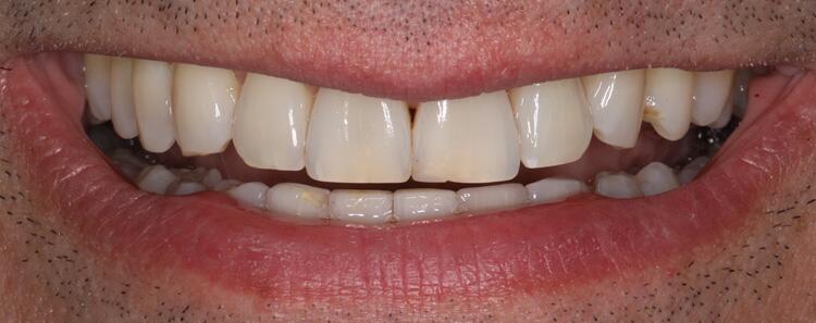 NuVeneers by Dr. Raanan Before & After Image