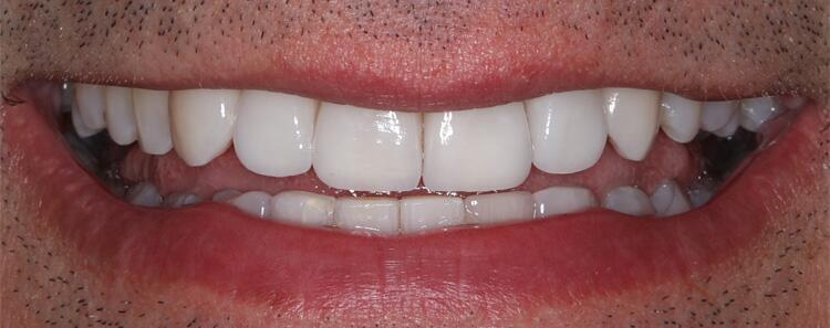 NuVeneers by Dr. Raanan Before & After Image