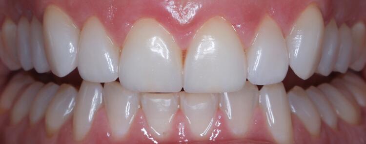 NuVeneers by Dr. Raanan Before & After Image