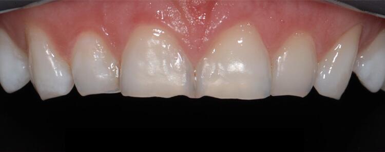 NuVeneers by Dr. Raanan Before & After Image