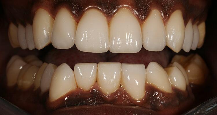 NuVeneers by Dr. Rifkin Before & After Image