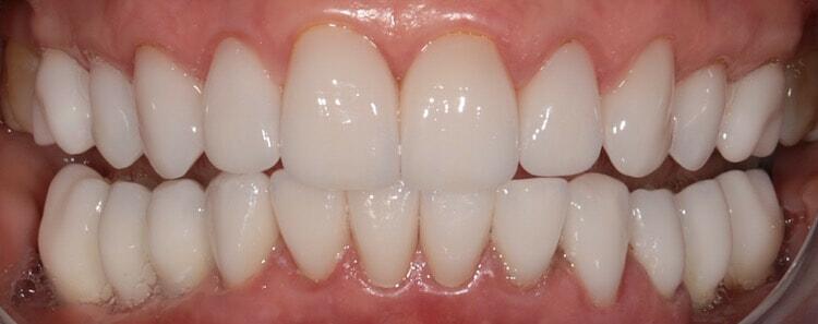 NuVeneers by Dr. Rifkin Before & After Image